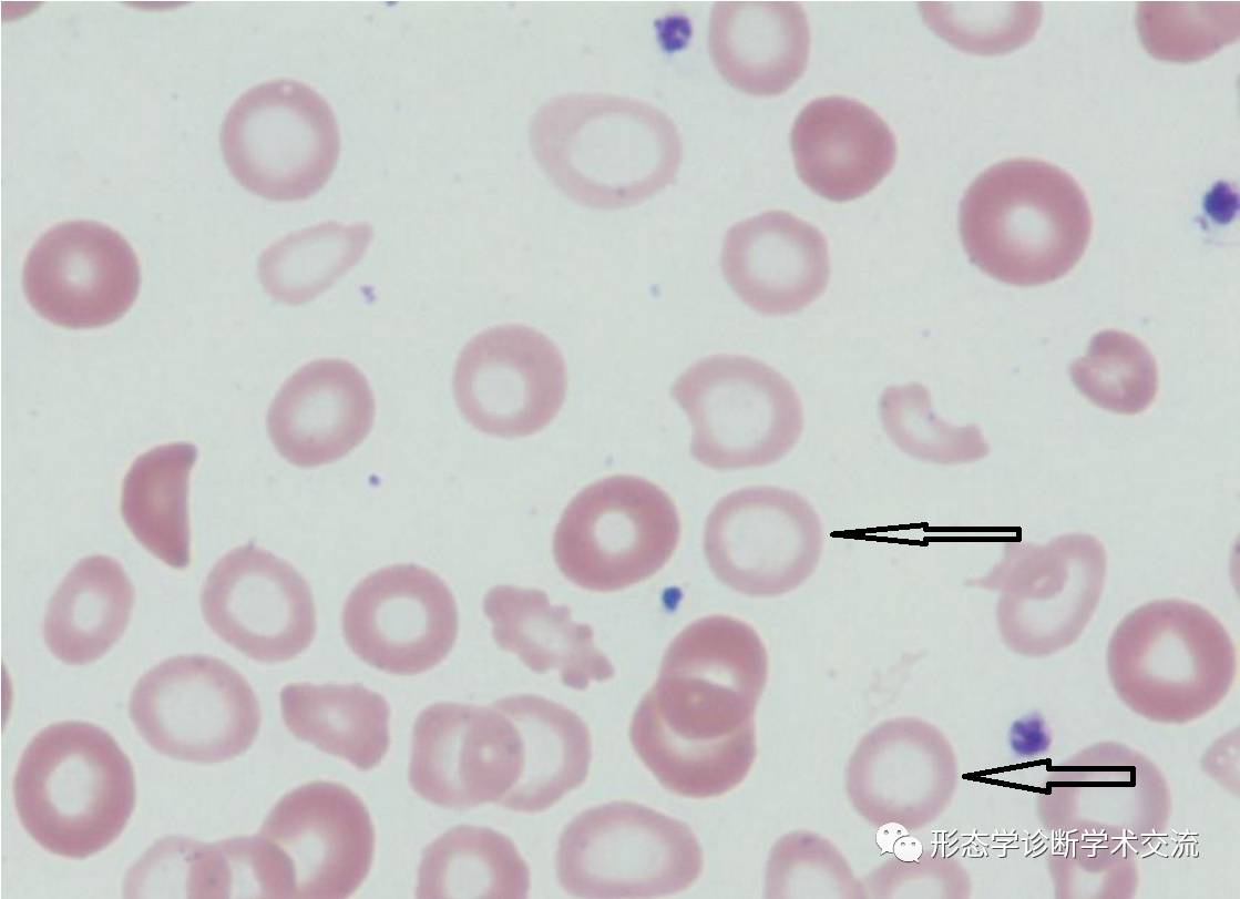 图3 嗜碱性点彩红细胞-临床医学-医学